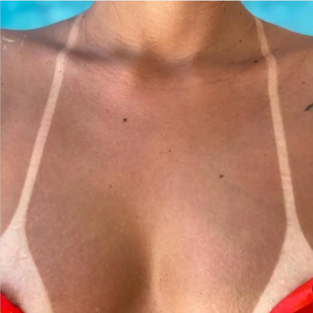 Resultado de bronzeamento na região dos ombros e colo, Romana Bronze