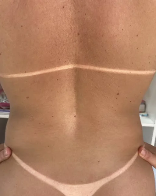 Resultado de bronzeamento nas costas, Romana Bronze
